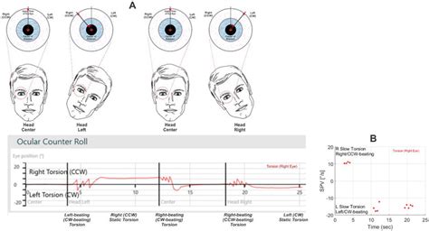 torsion eye test|torsional eye movements definition.